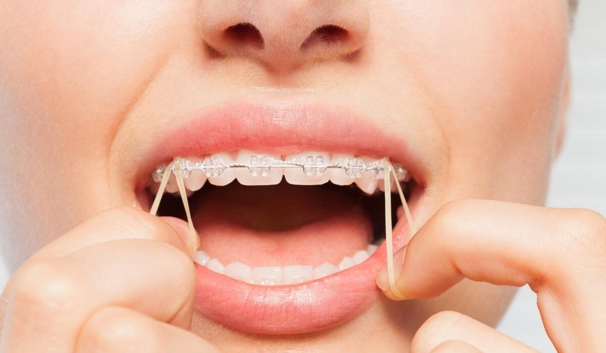 Ortodontik tedavi sürecinde diş teli ve şeffaf plak kullanımına bağlı olarak hissedilen geçici hassasiyet ve baskı hissi