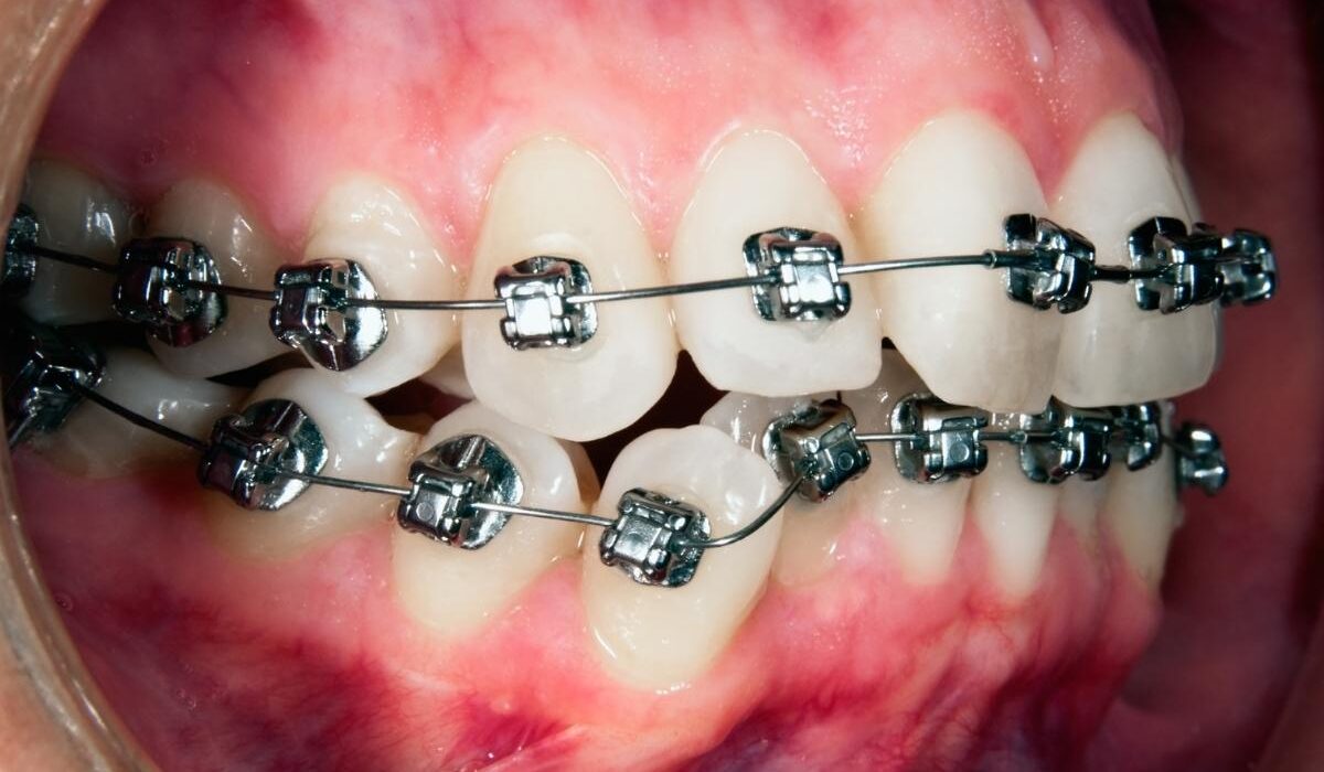 Ortodontik tedavi sırasında diş eti sağlığının korunması için doğru ağız hijyeni ve düzenli bakım uygulamaları