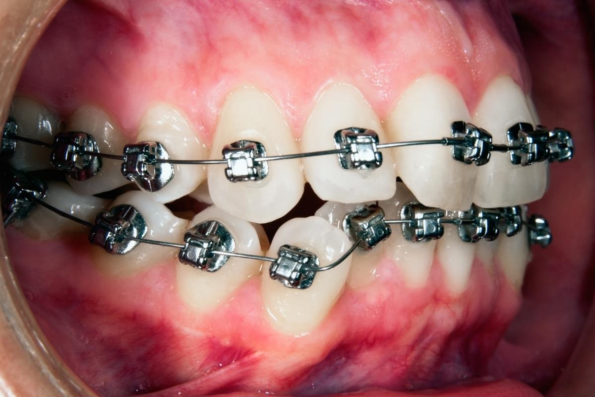 Ortodontik tedavi sırasında diş eti sağlığının korunması için doğru ağız hijyeni ve düzenli bakım uygulamaları