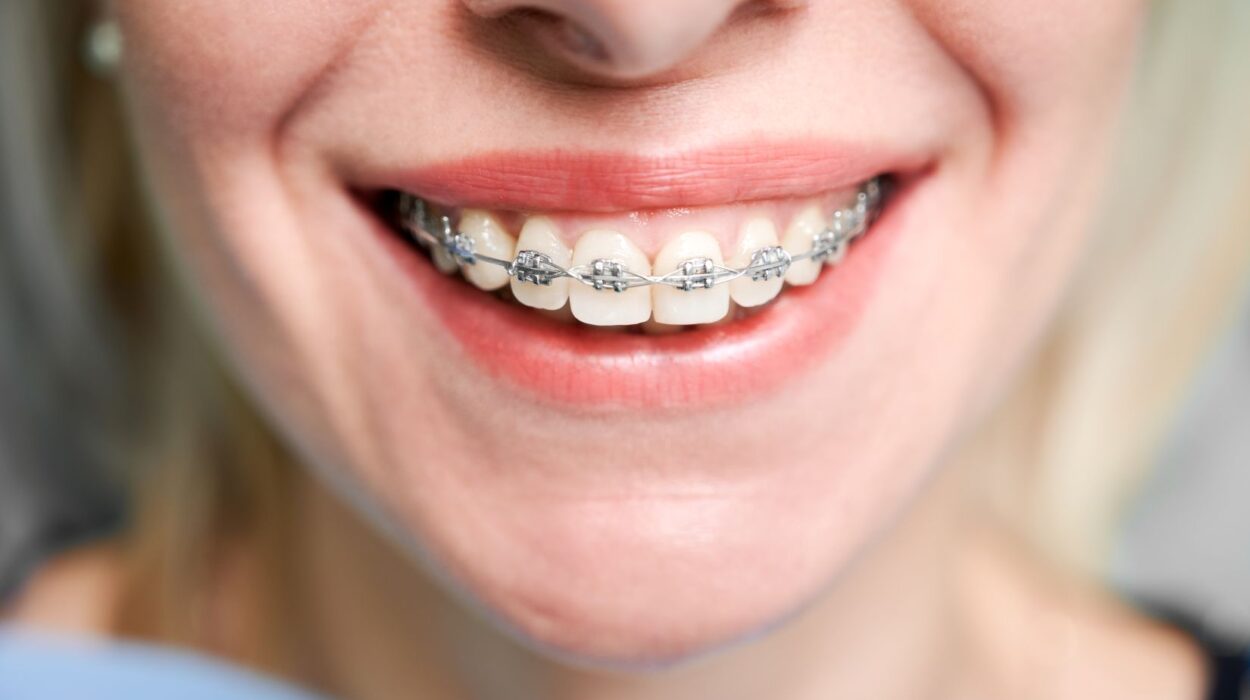 Ortodontik tedavi yöntemleri: Geleneksel diş teli ve şeffaf plak (Invisalign) uygulamasının karşılaştırmalı görünümü.