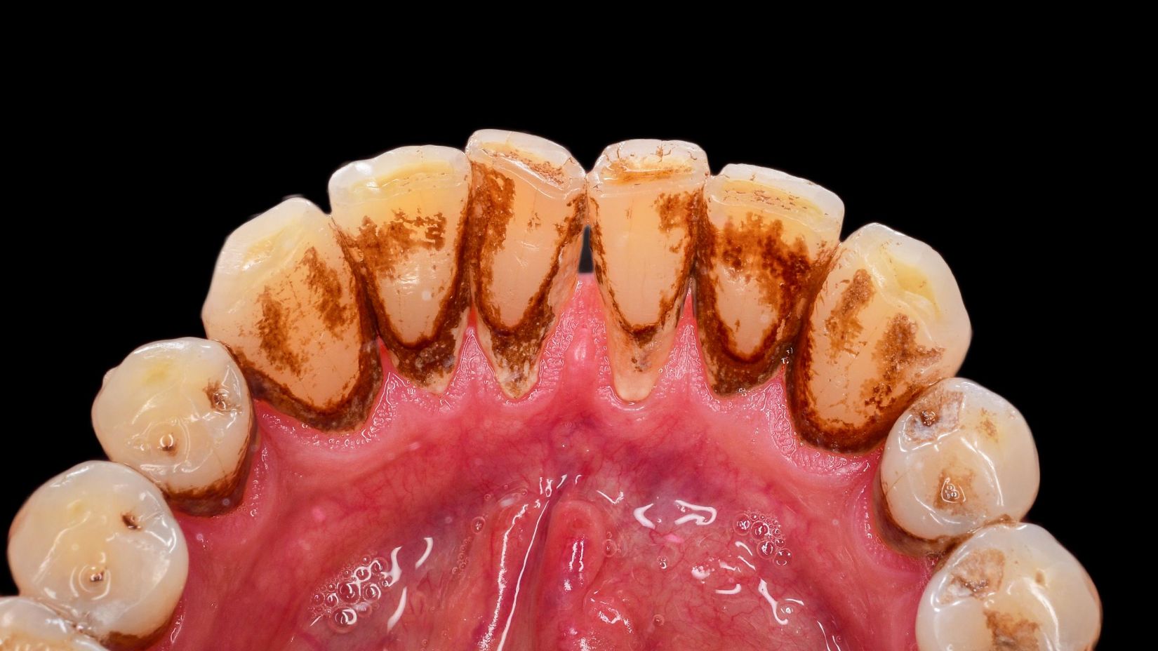 Diş yüzeyinde biriken dental plağın zamanla sertleşerek diş taşına dönüşmesini gösteren ağız sağlığı görseli