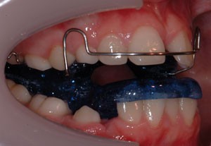 Çocuklarda kullanılan hareketli ortodontik apareylerin çene gelişimi ve diş konumuna etkisini gösteren görsel