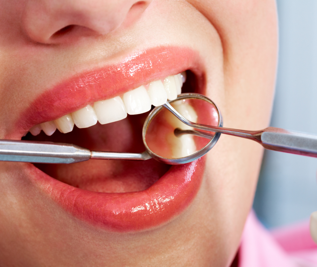 Konya kompozit dolgu sonrası doğal görünümlü diş restorasyonu