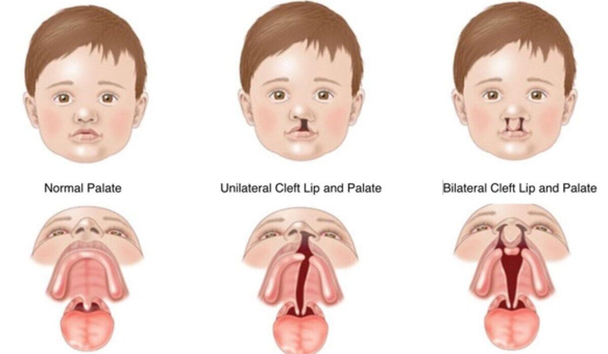 Dudak ve damak yarığı olan bireylerde ortodontik tedavi süreci ve diş gelişimini gösteren ortodonti görseli