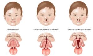 Dudak ve damak yarığı olan bireylerde ortodontik tedavi süreci ve diş gelişimini gösteren ortodonti görseli