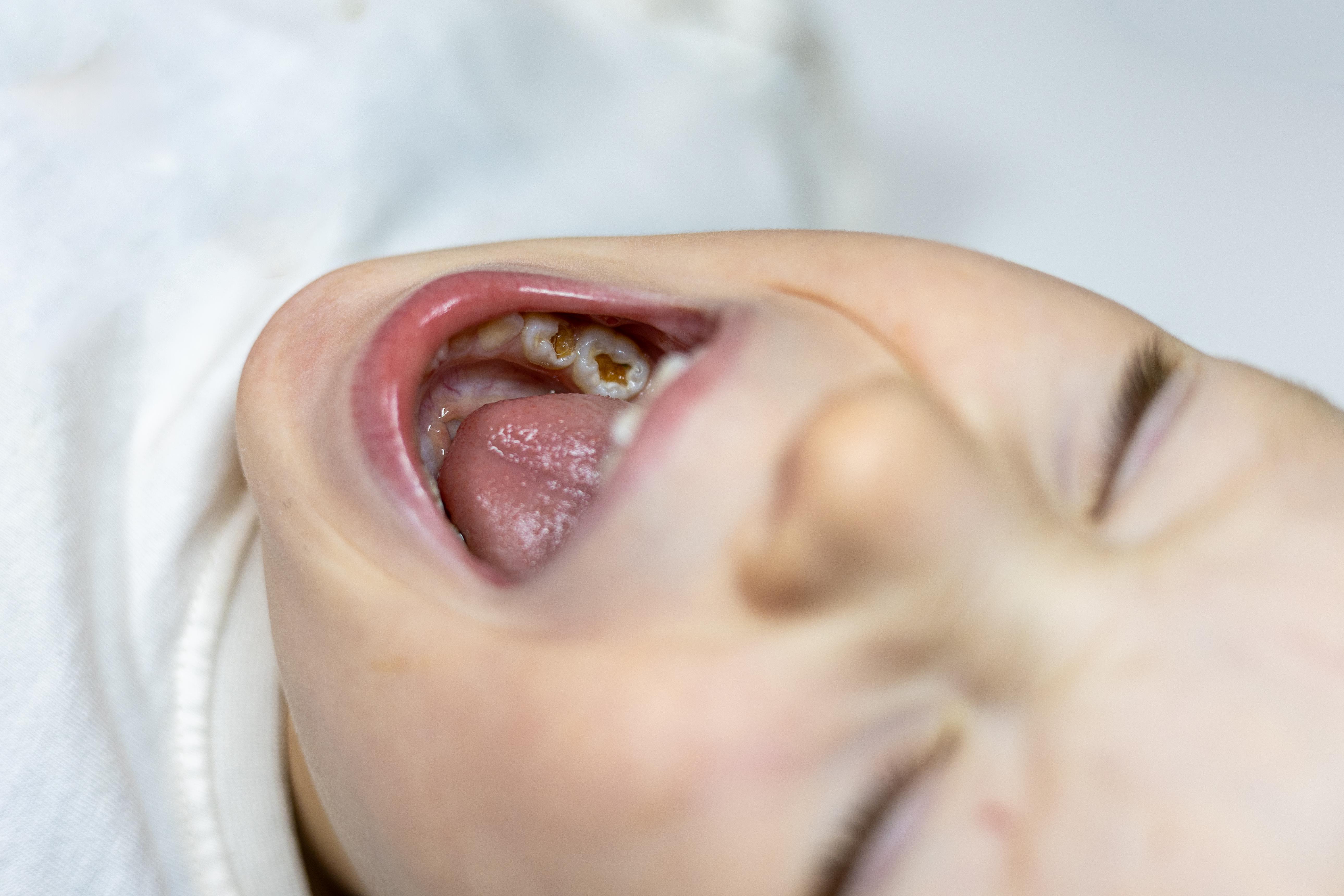 Biberon çürüğü oluşmuş çocuk dişlerini ve erken çocukluk çürüklerini gösteren diş sağlığı görseli