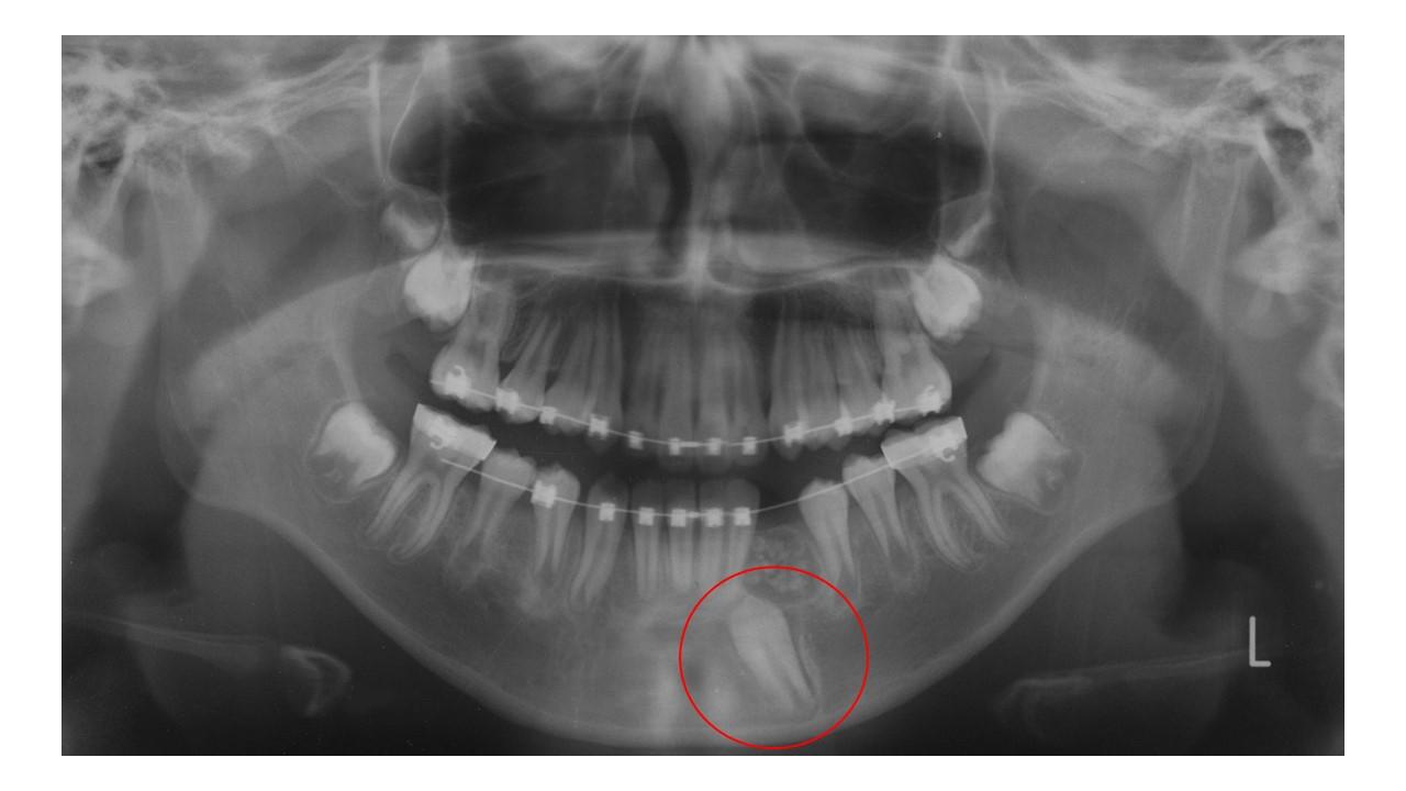 Gömülü dişin ortodontik tedavi ile sürdürülmesini gösteren röntgen ve diş yapısı görseli