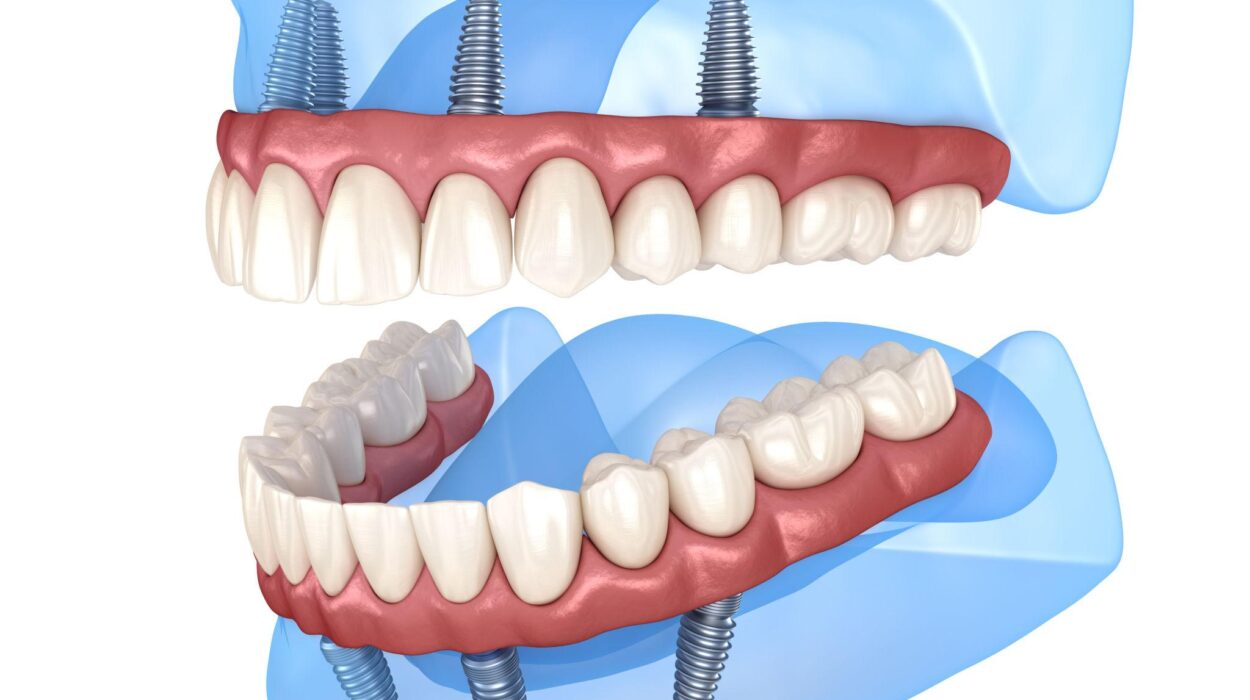 All-on-4 ve All-on-6 implant sistemleri ile sabit protez uygulamasını gösteren diş implantı görseli