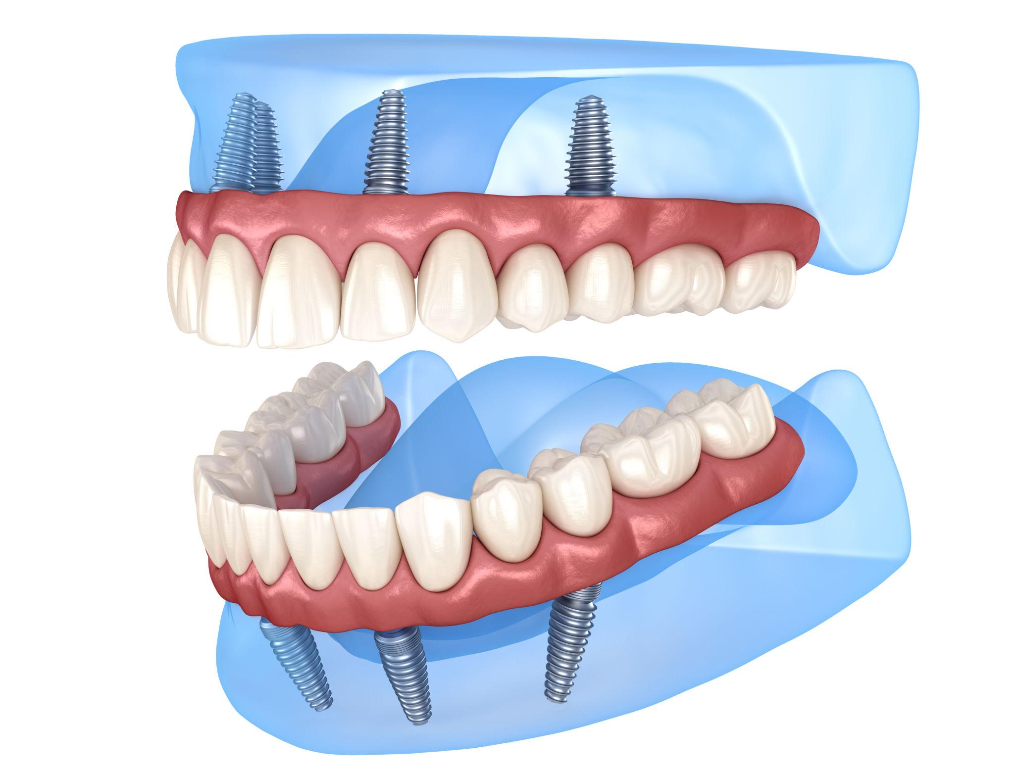 All-on-4 ve All-on-6 implant sistemleri ile sabit protez uygulamasını gösteren diş implantı görseli