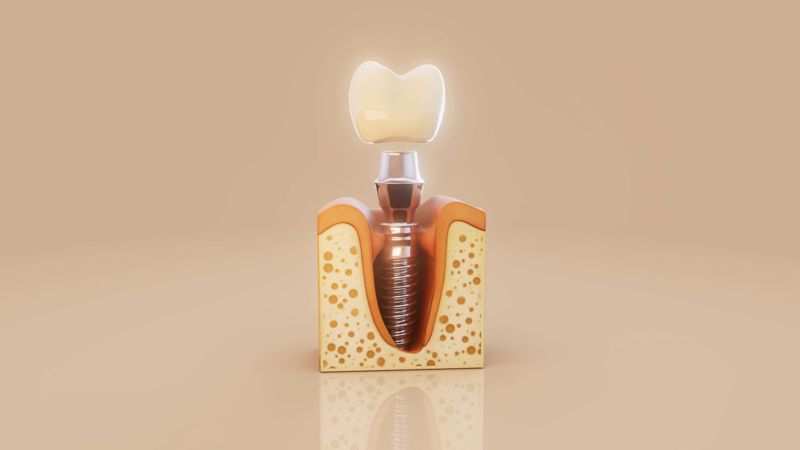 Tek diş eksikliğinde implant uygulaması ve diş yapısını gösteren implant tedavi süreci görseli