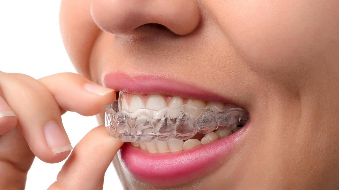 Ortodontik tedavi sonrası sabit ve hareketli retainer kullanımını gösteren diş hekimliği görseli