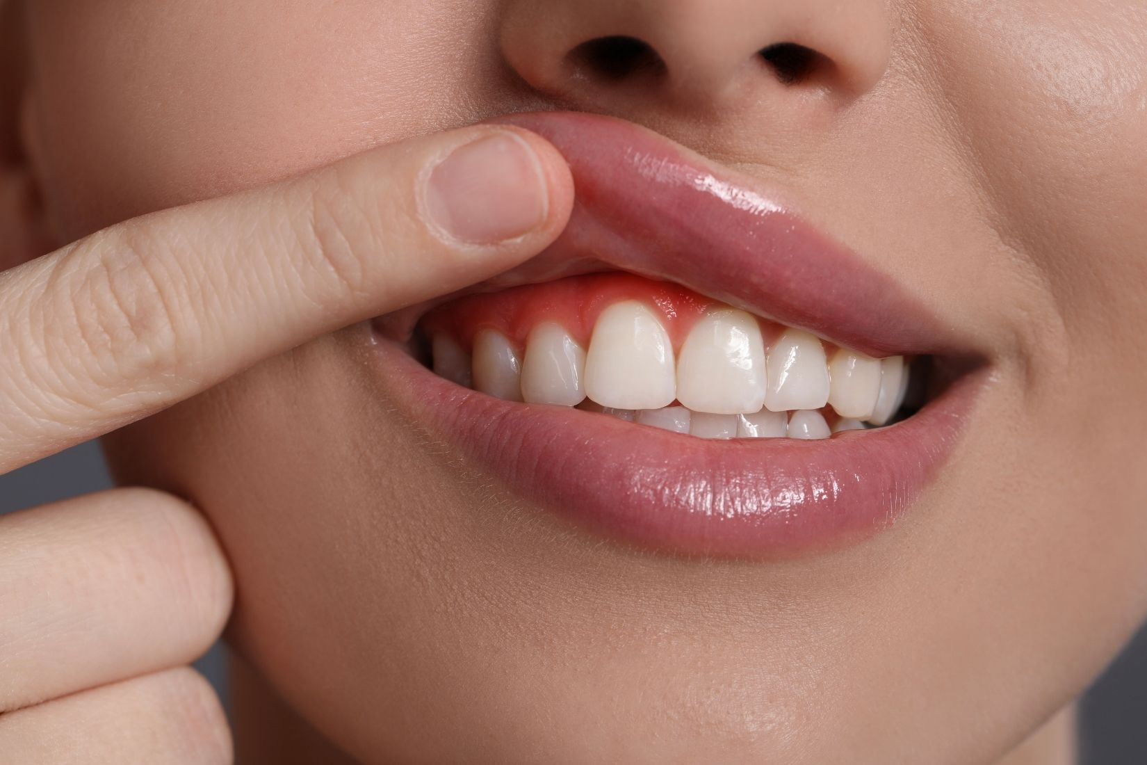 Diş eti tedavisi planlaması öncesinde periodontal dokuların klinik olarak değerlendirildiği ağız içi muayene görüntüsü.