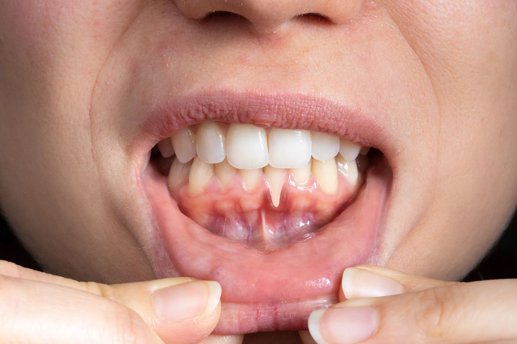Diş eti çekilmesi bulunan dişlerde kök yüzeyi ve periodontal dokuların klinik olarak değerlendirildiği ağız içi muayene.