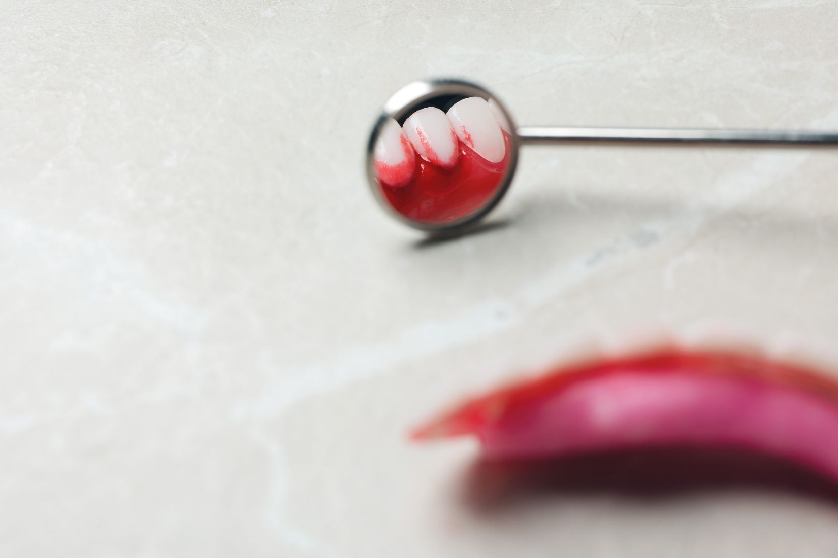 Diş eti çekilmesi bulunan bölgede kök yüzeyi ve yumuşak dokuların periodontal olarak değerlendirildiği klinik görüntü.