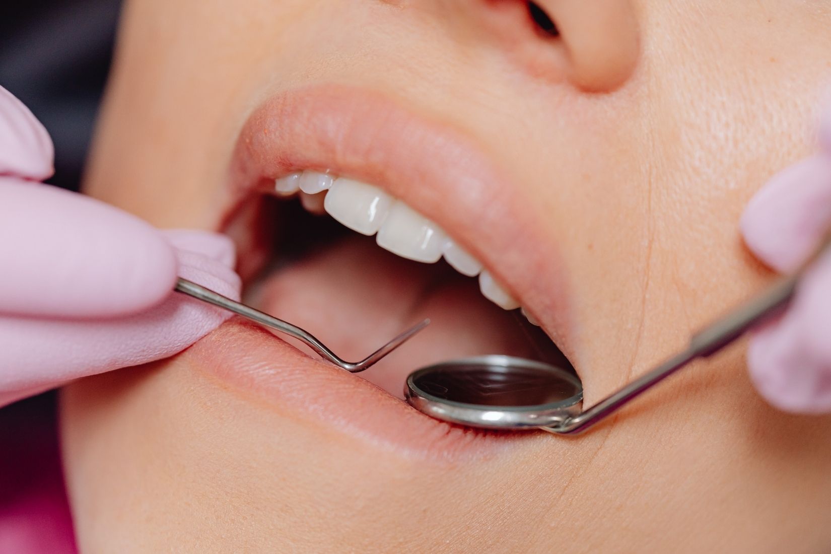 Kompozit bonding uygulanmış ön dişlerde renk uyumu ve yüzey parlaklığının klinik olarak değerlendirildiği ağız içi görüntü.