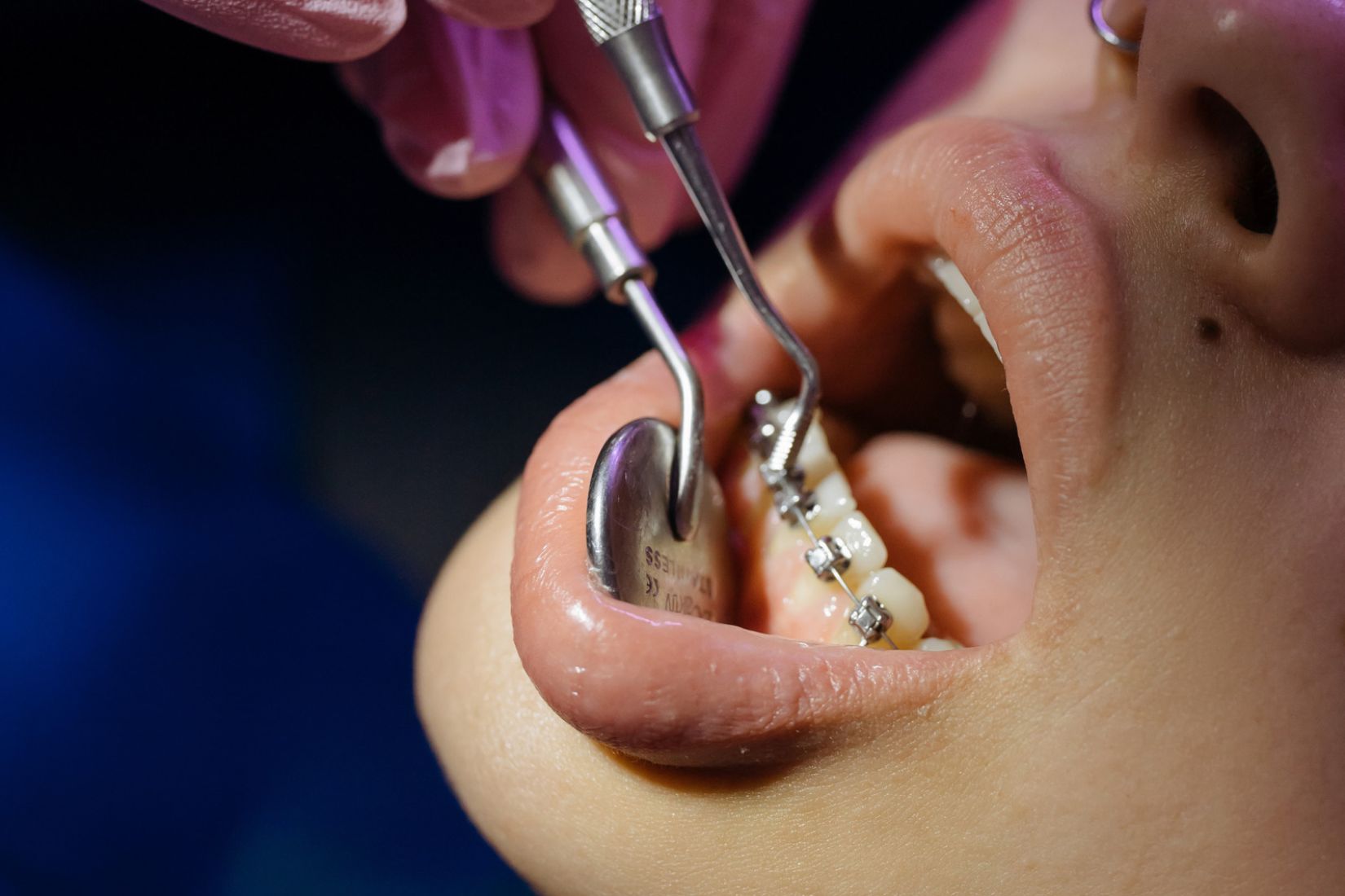 Eksik diş bölgesinin implant öncesinde diş konumları, kök aralıkları ve kapanış açısından değerlendirilmesi.